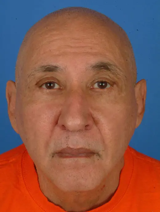 Male Facelift and Eyelid Surgery 60244 Front view  1 yr 7mo Post-Op