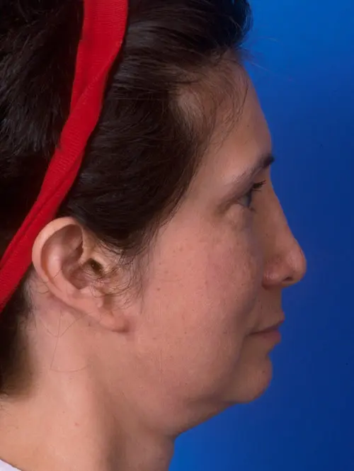 60264 Revision Rhinoplasty and Facelift Profile View Pre Op