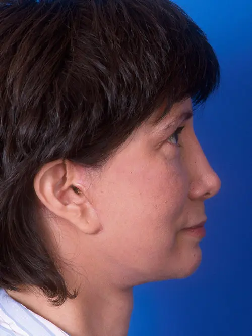 60264 Revision Rhinoplasty and Facelift Profile View 3 months Post Op