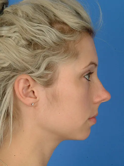 64082 Rhinoplasty surgery before profile view