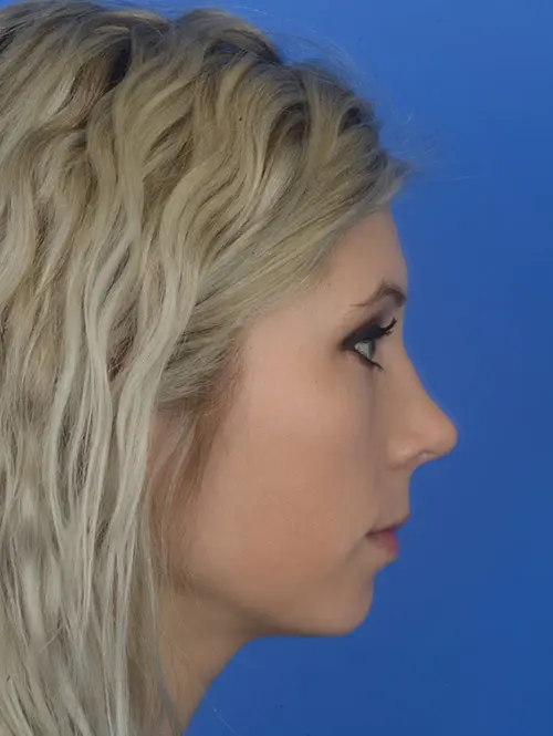 64082 Rhinoplasty surgery after profile view