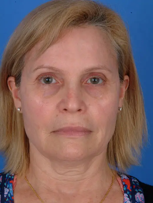 Facelift Laser Skin Resurfacing Brow Lift Endoscopic Browlift. 11117 front view pre op