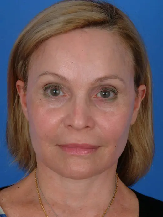 Facelift Laser Skin Resurfacing Brow Lift Endoscopic Browlift. 11117 front view post op