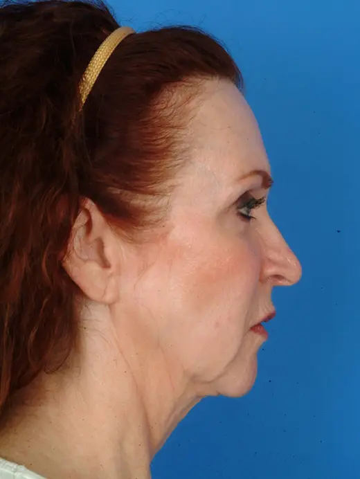 Multiple-Procedures-Work-Well | Before Facelift