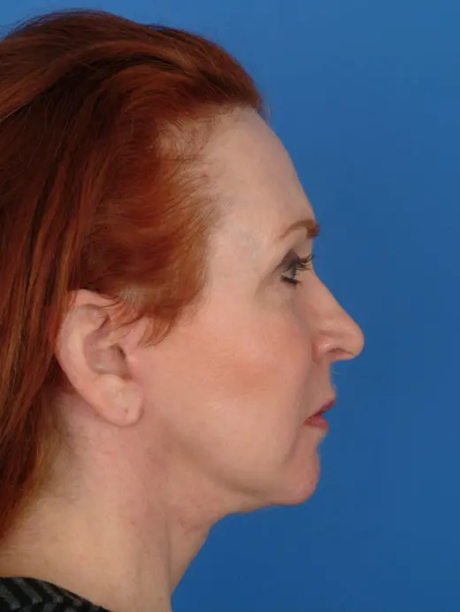 Multiple-Procedures-Work-Well | After Facelift