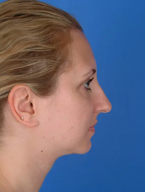 11588 Rhinoplasty Profile Before Surgery