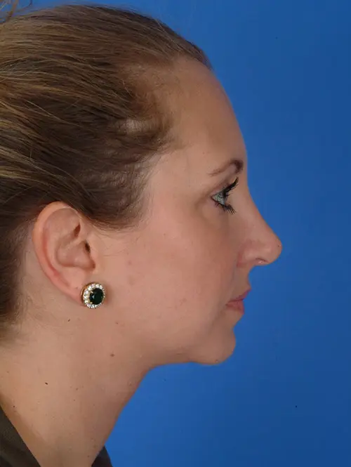 11588 Rhinoplasty Profile 1 year post op