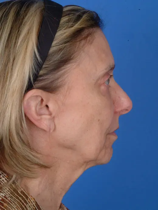60 year old facelift surgery. 11590 profile view pre op