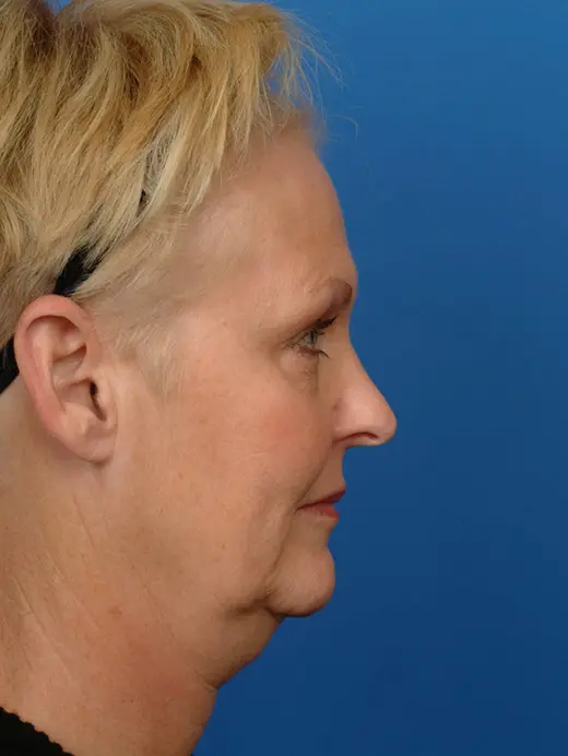 Facelift and laser skin resurfacing. 11592 profile view pre op