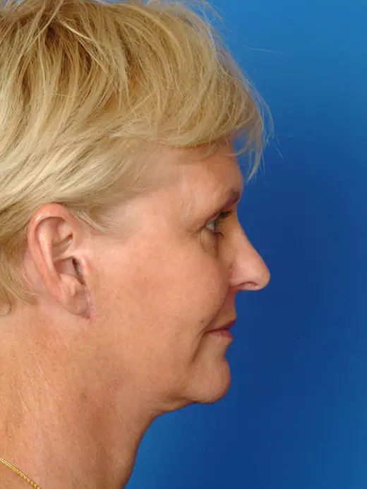 Facelift and laser skin resurfacing. 11592 profile view post op