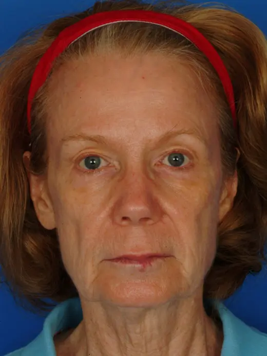 Facelift, upper eyelid surgery, cheek augmentation. 11593 front view pre op
