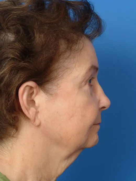 Facelift Eyelid Surgery Cervicofacial rhytidectomy Lower Eyelid Surgery Bilateral Blepharoplasty. 11623 profile view pre op