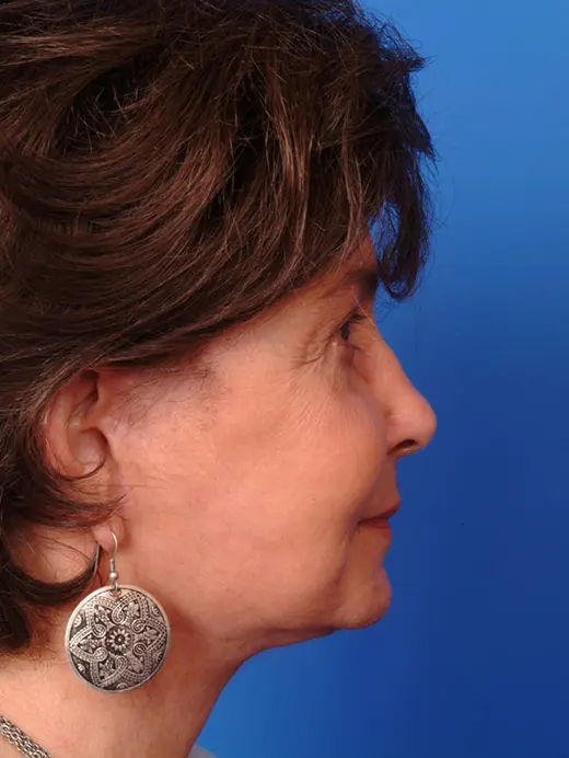 Facelift Eyelid Surgery Cervicofacial rhytidectomy Lower Eyelid Surgery Bilateral Blepharoplasty. 11623 profile view post op