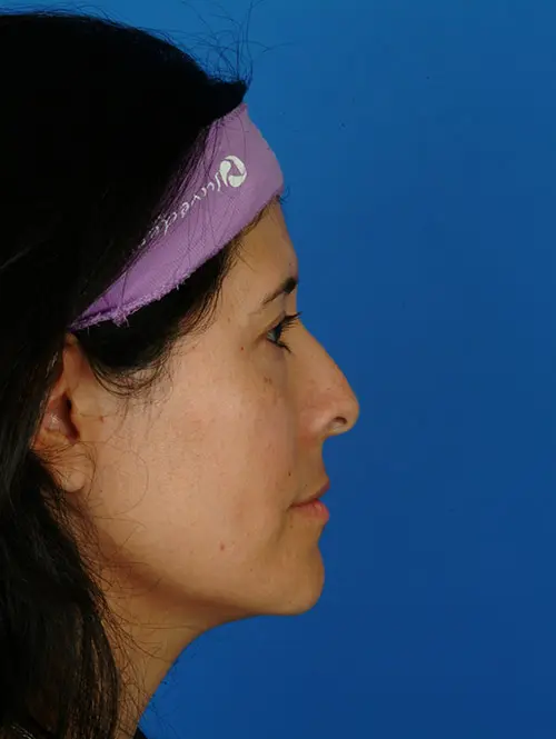 11635 Rhinoplasty and Eyelid Surgery Before Profile View