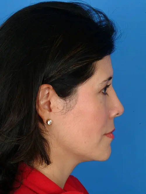 11635 Rhinoplasty and Eyelid Surgery After Profile View