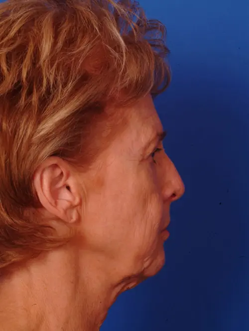 Facelift and Rhinoplasty 11637 Profile View Before