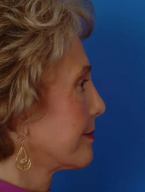 Facelift and Rhinoplasty 11637 Profile View After
