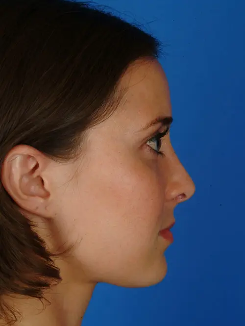 11646 Rhinoplasty After Profile View