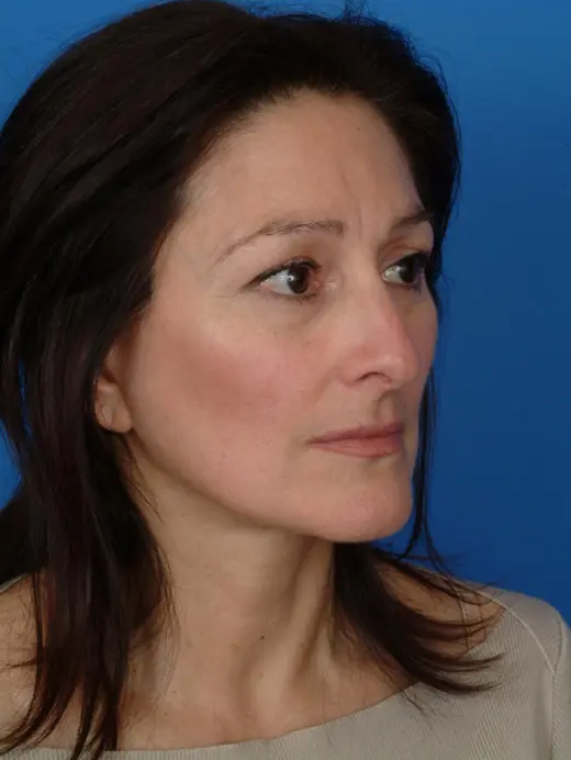Facelift, brow lift, upper and lower eyelid surgery. 11661 oblique view post op