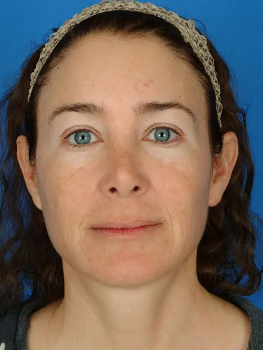 Laser Skin Resurfacing Full Face CO2 Before Treatment