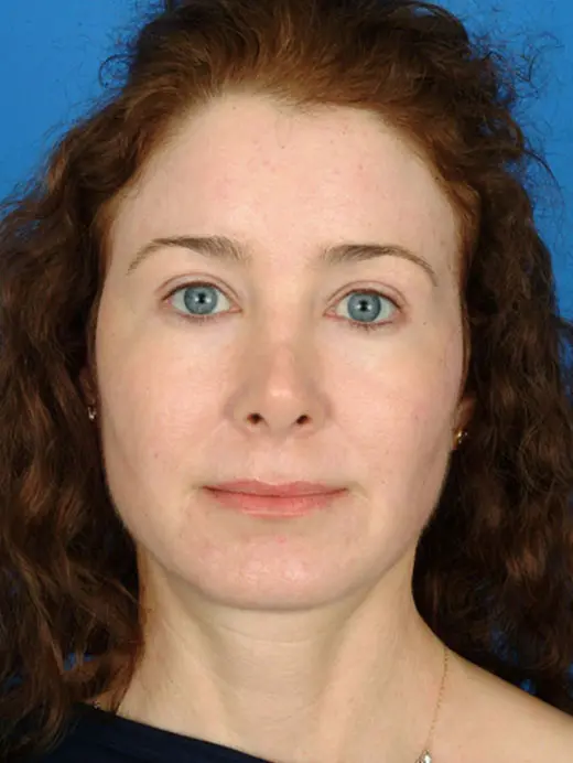 Laser Skin Resurfacing Full Face CO2 After Treatment