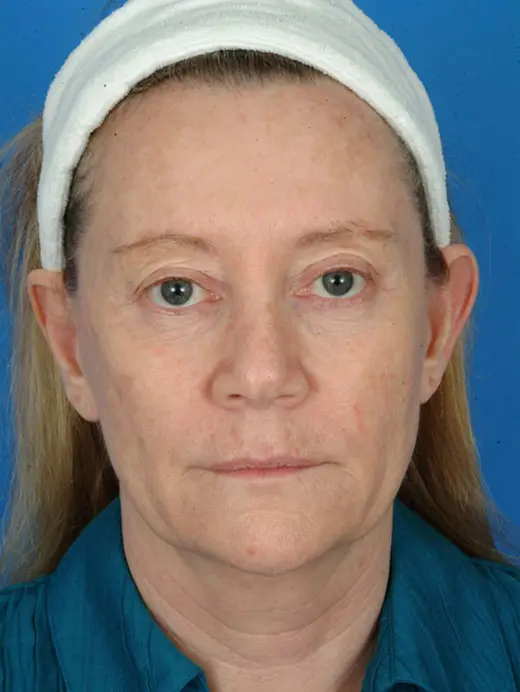 Full Face CO2 Laser Skin Resurfacing Facial Rejuvenation 11673 Front View Before Treatment