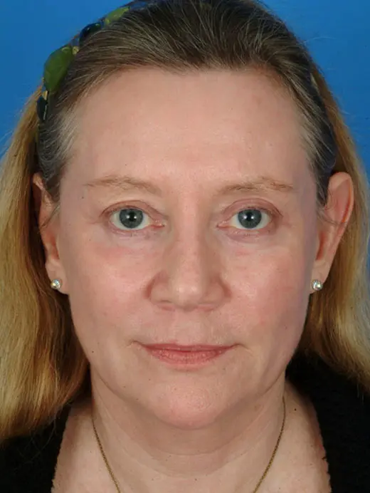 Full Face CO2 Laser Skin Resurfacing Facial Rejuvenation 11673 Front View After Treatment