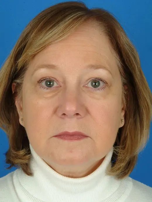 Eyelid Surgery Lower Eyelid Surgery Bilateral Blepharoplasty 11677 Front View Pre Op