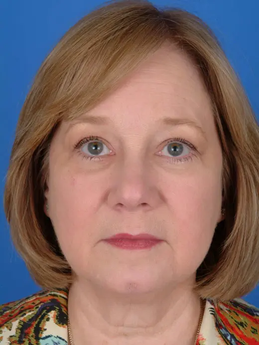 Eyelid Surgery Lower Eyelid Surgery Bilateral Blepharoplasty 11677 Front View Post Op