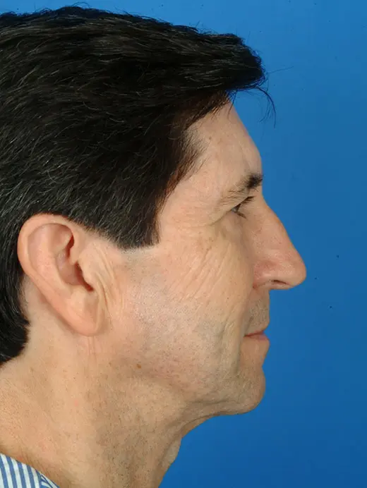 11678 Facelift with Browlift, and Lower Eyelid Surgery. Profile view pre op