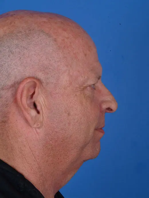 Facelift and Upper Eyelid Surgery 11682 profile view pre op