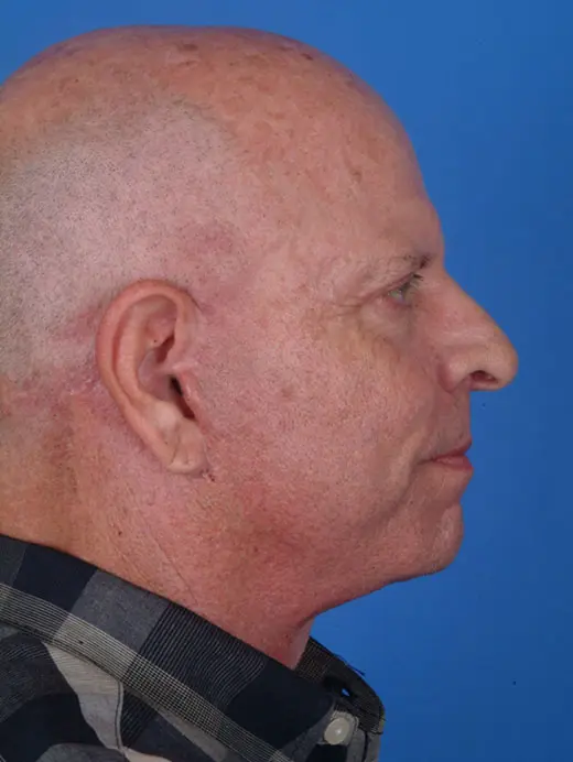 Facelift and Upper Eyelid Surgery 11682 profile view 2 1/2 Months Post Op