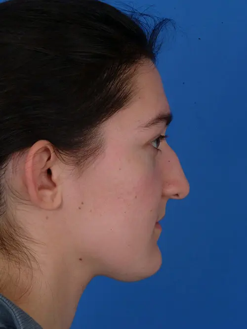 Nasal valve repair rhinoplasty 12314 profile view before surgery