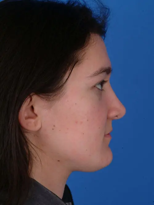 Nasal valve repair rhinoplasty 12314 profile view after surgery