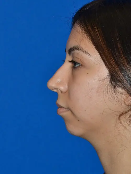 Nose Reshaping Rhinoplasty 78995 Pre Side