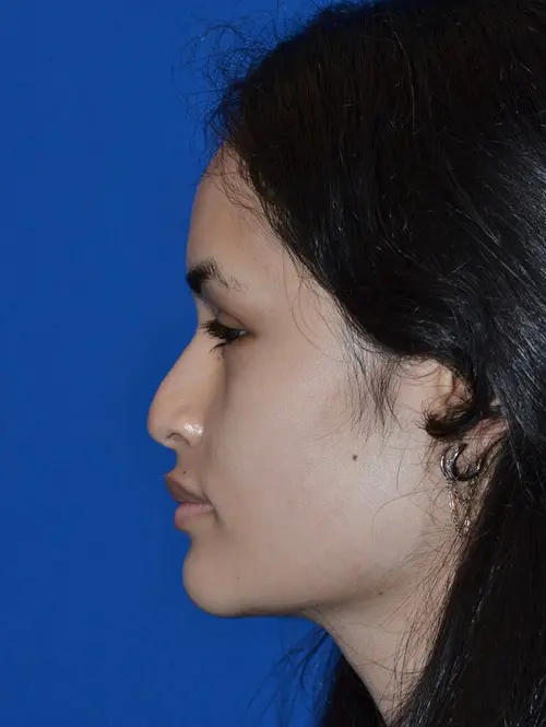 Complex rhinoplasty 78997 Pre Side
