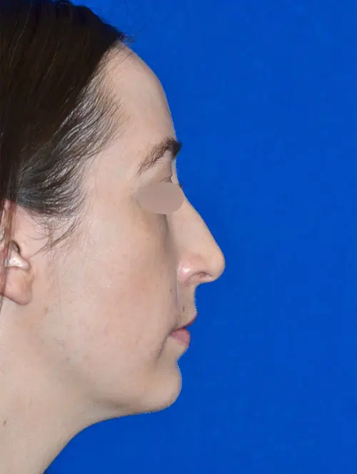Rhinoplasty Septoplasty and turbinate reduction 78992 Side - Before