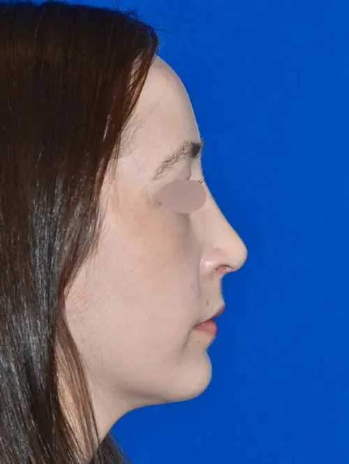 Rhinoplasty Septoplasty and turbinate reduction 78992 Side - After