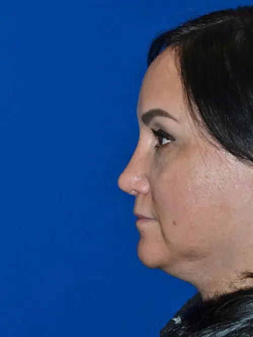 Revision rhinoplasty 79053 Profile View After