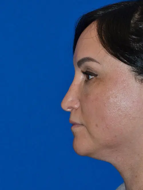 Revision rhinoplasty 79053 Profile View Before