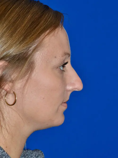 Primary Rhinoplasty 79054 Pre SIde