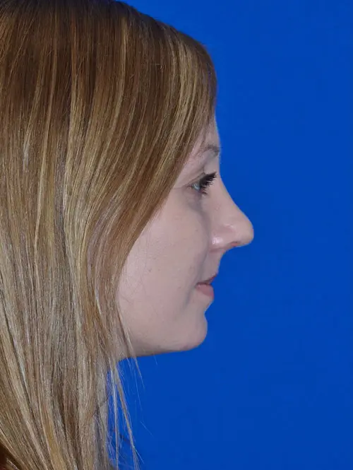 Primary Rhinoplasty 79054 Post SIde