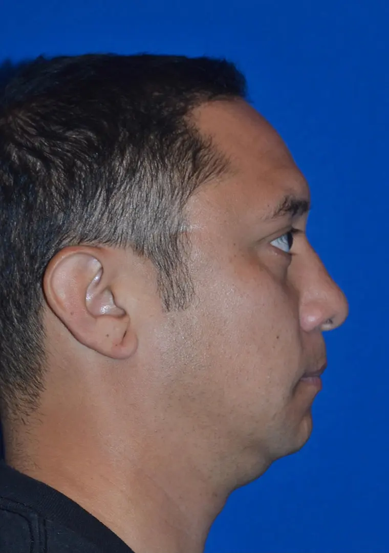 Rib Graft Ethnic Rhinopasty 79893 Pre Profile