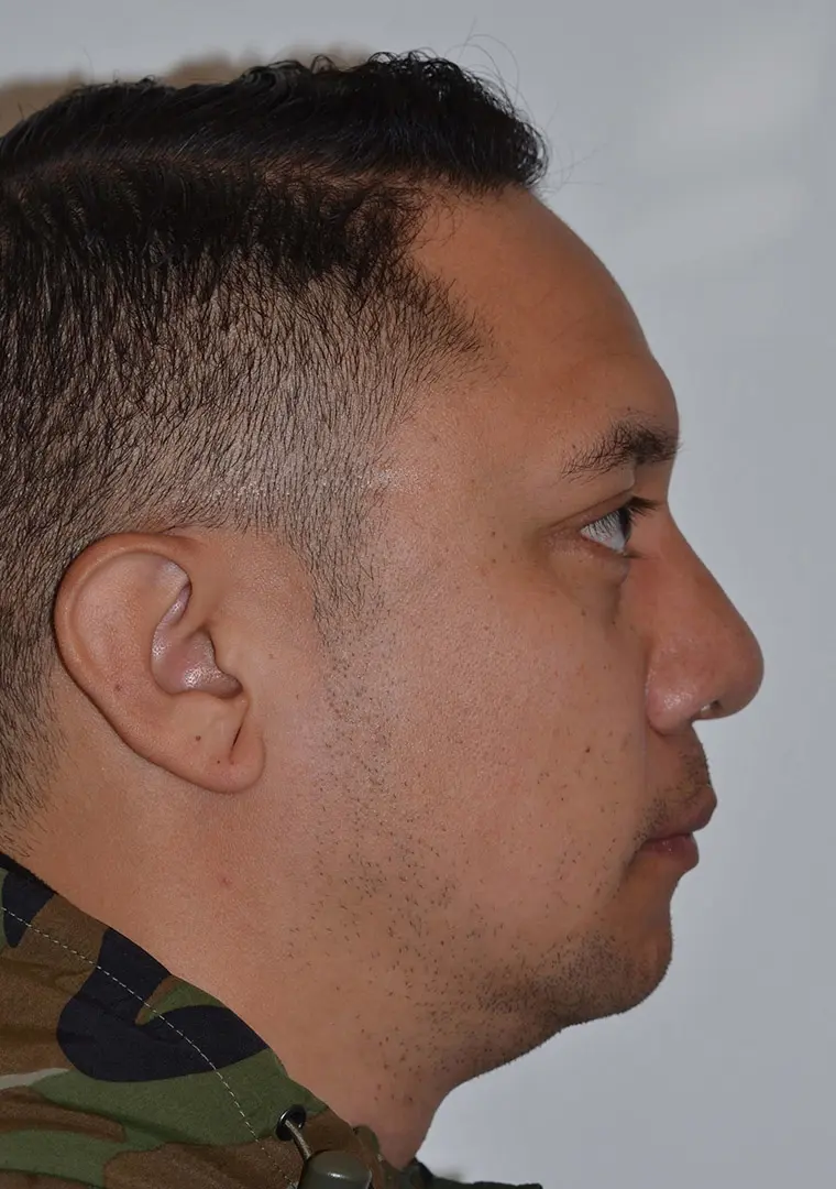 Rib Graft Ethnic Rhinopasty 79893 Post Profile