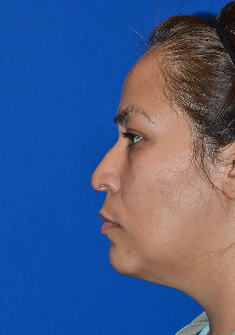 Cosmetic-Rhinoplasty-and-Revision-Septoplasty-to-improve-breathing-in-Houston | Before Ethnic Rhinoplasty
