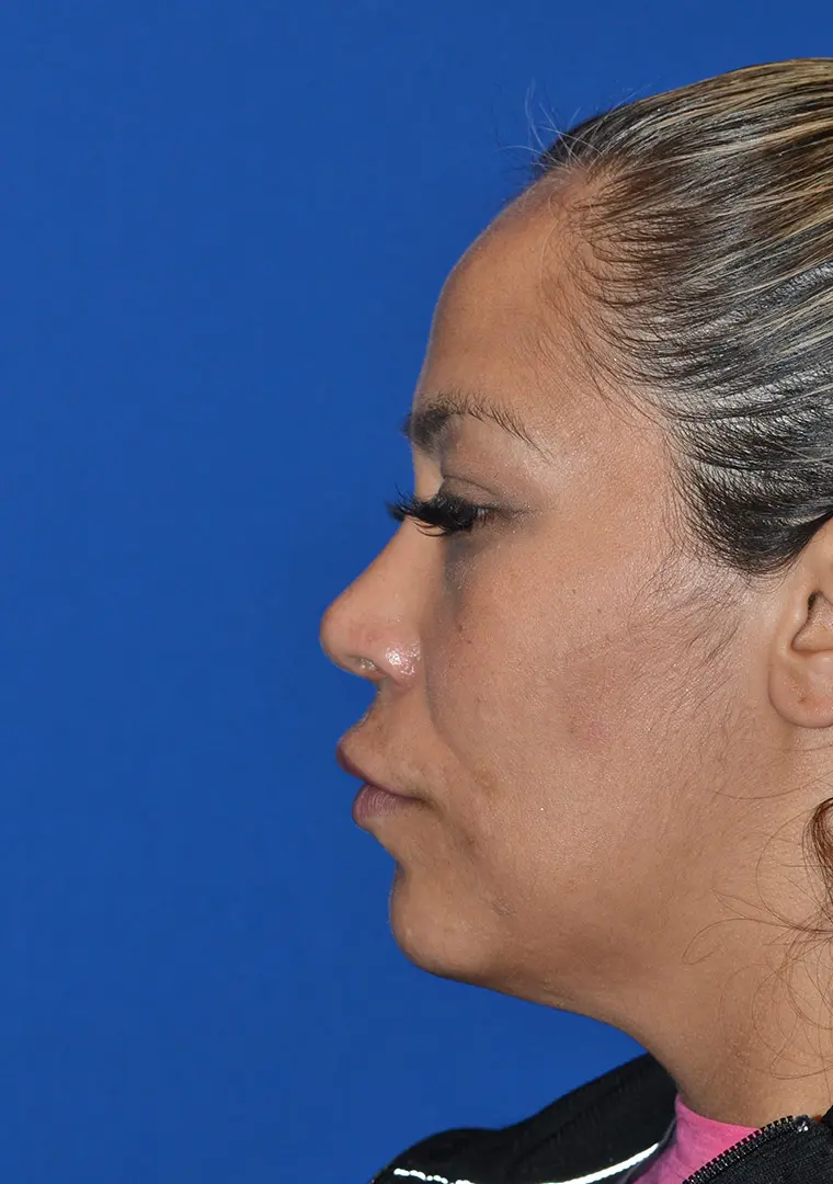 Cosmetic-Rhinoplasty-and-Revision-Septoplasty-to-improve-breathing-in-Houston | After Ethnic Rhinoplasty