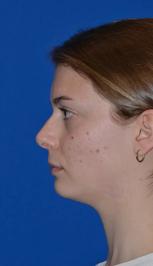 Rhinoplasty-to-correct-the-congenitally-crooked-nose | Before Ethnic Rhinoplasty