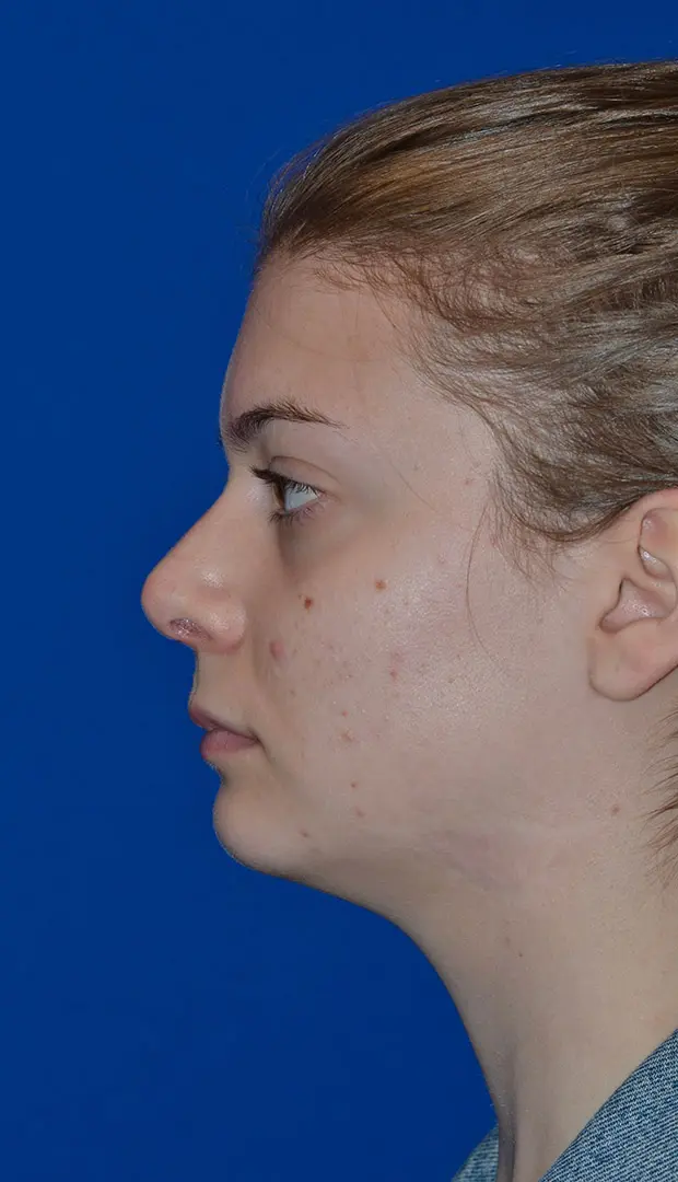 Rhinoplasty-to-correct-the-congenitally-crooked-nose | After Ethnic Rhinoplasty