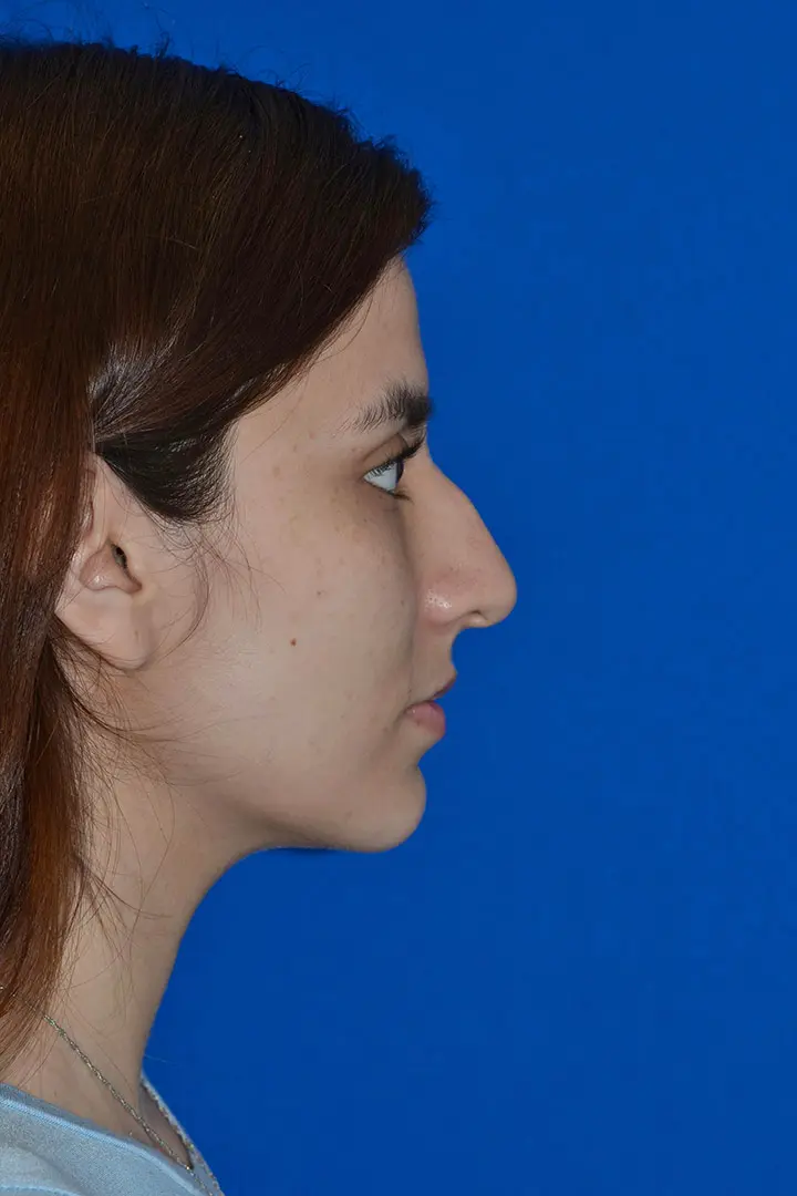 79901 rhinoplasty Pre Side