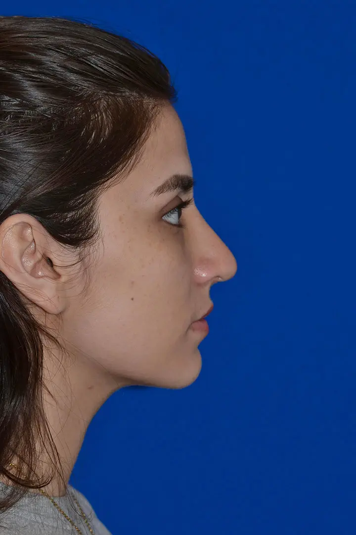 79901 rhinoplasty Post Side